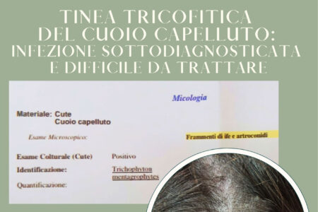 Tinea Tricofitica del cuoio capelluto: Infezione diagnosticata e difficile da trattare